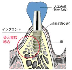 インプラント